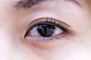 子宮頚部上皮内癌の治療の方法や状態