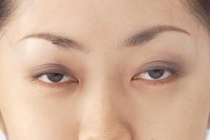 日本橋Fレーザークリニックのホクロ治療